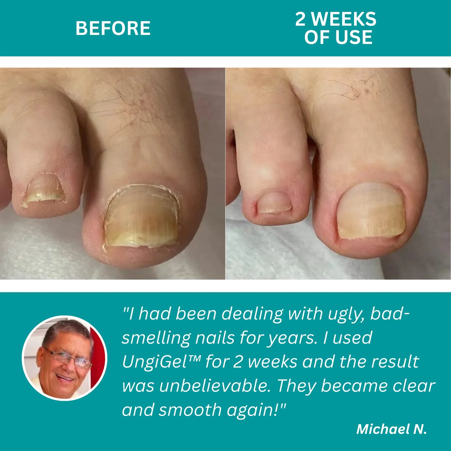 UngiGel – Fungal Adhesive Patches