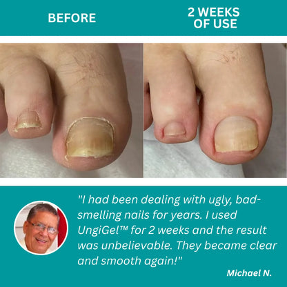 UngiGel – Fungal Adhesive Patches