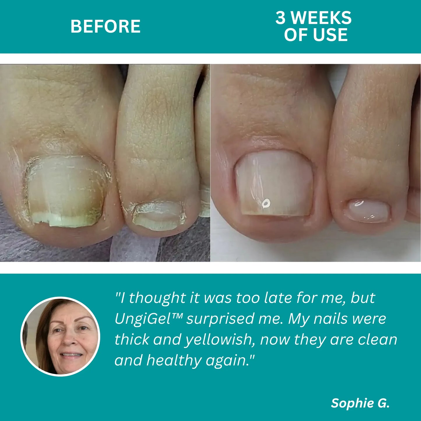 UngiGel – Fungal Adhesive Patches
