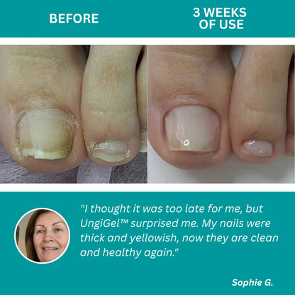 UngiGel – Fungal Adhesive Patches