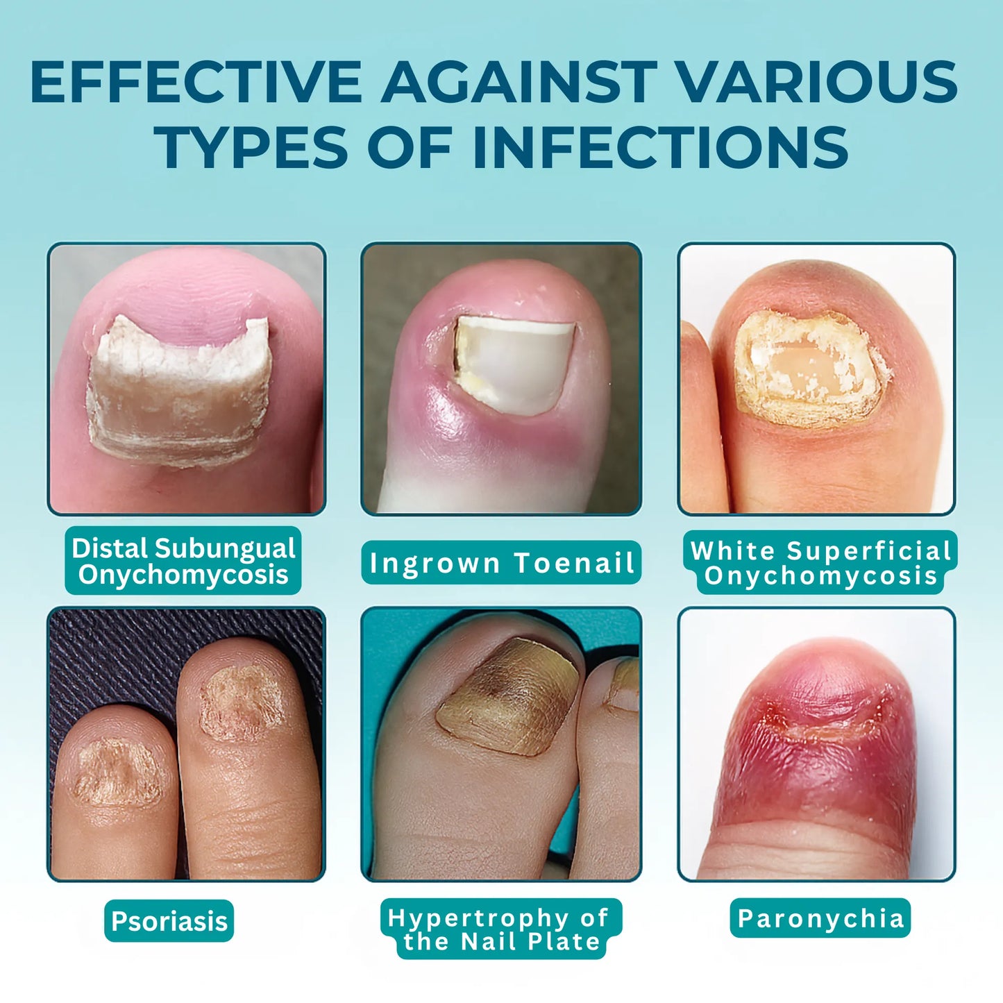 UngiGel – Fungal Adhesive Patches