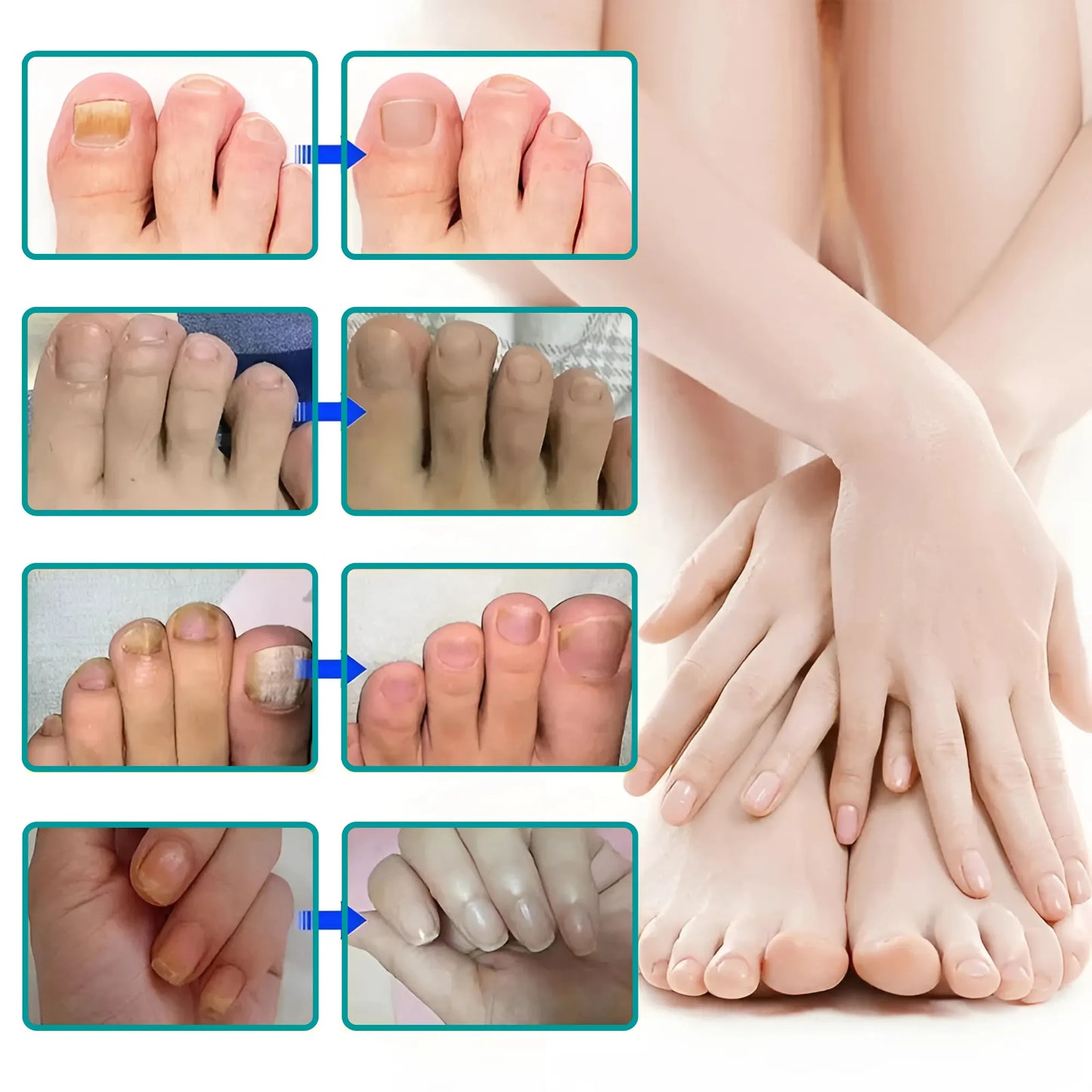 UngiGel – Fungal Adhesive Patches