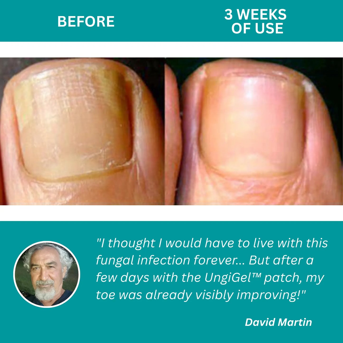 UngiGel – Fungal Adhesive Patches