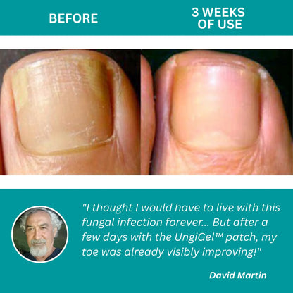 UngiGel – Fungal Adhesive Patches